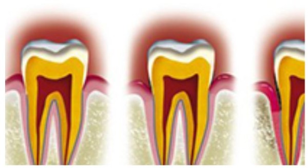 Qu’est-ce qu’une maladie parodontale ?