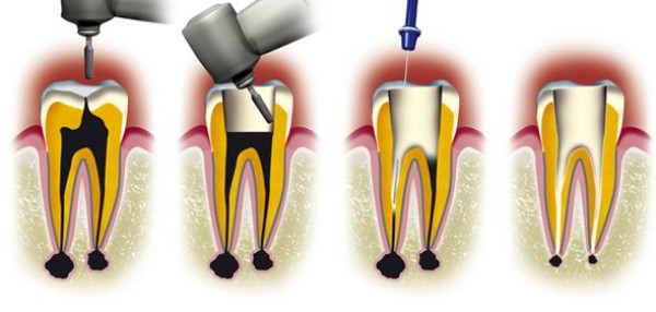 Cas clinique : Traitements endodontiques
