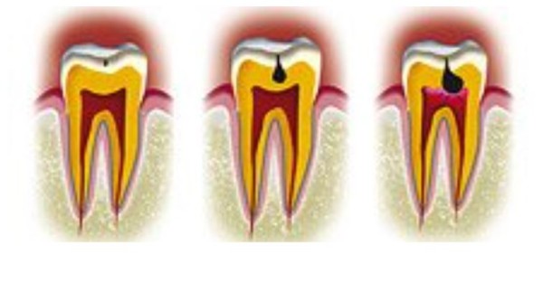 Les différentes pathologies dentaires