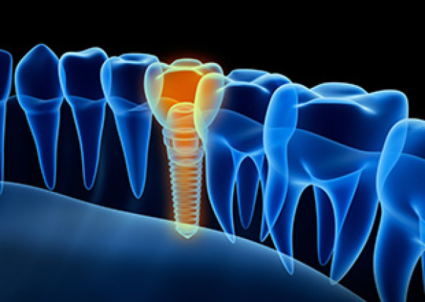 Cas clinique : Les implants dentaires