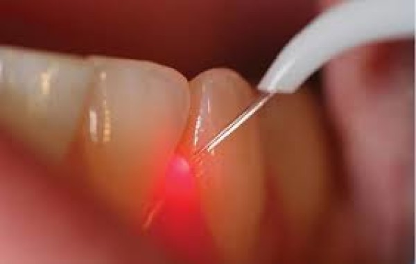 Pourquoi utiliser le laser en dentisterie ?